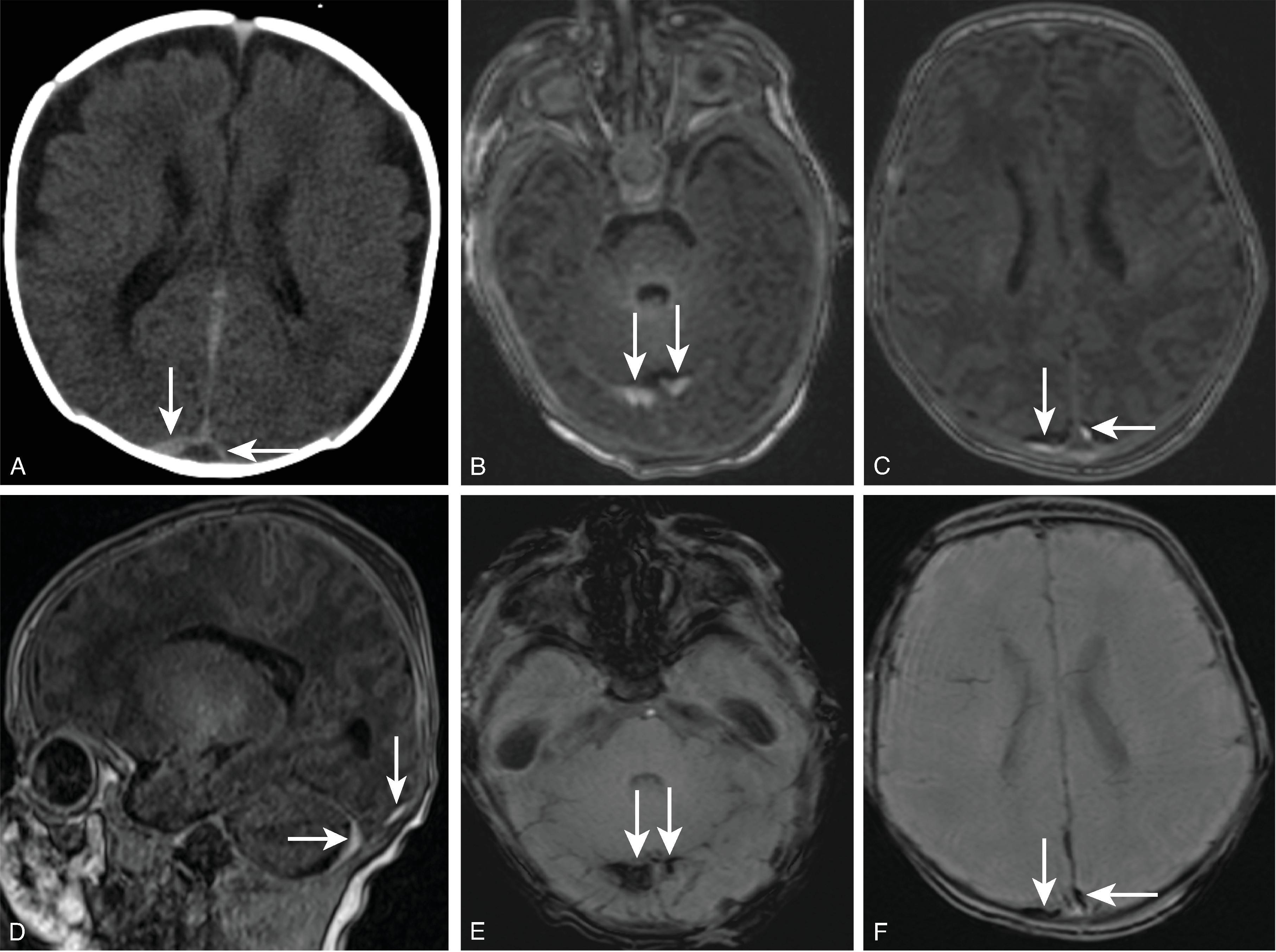 Fig. 10.5, Birth-Related Subdural Hemorrhage . (A) Axial head CT demonstrating hyperdense subdural hemorrhage along the right and left sides of the posterior falx ( arrows ). (B, C, D) Axial and sagittal T1W images demonstrating T1W hyperintense subdural hemorrhage along the tentorium, occipital lobes and posterior to the cerebellar hemispheres with associated susceptibility on (E and F) axial SWI images ( arrows ).