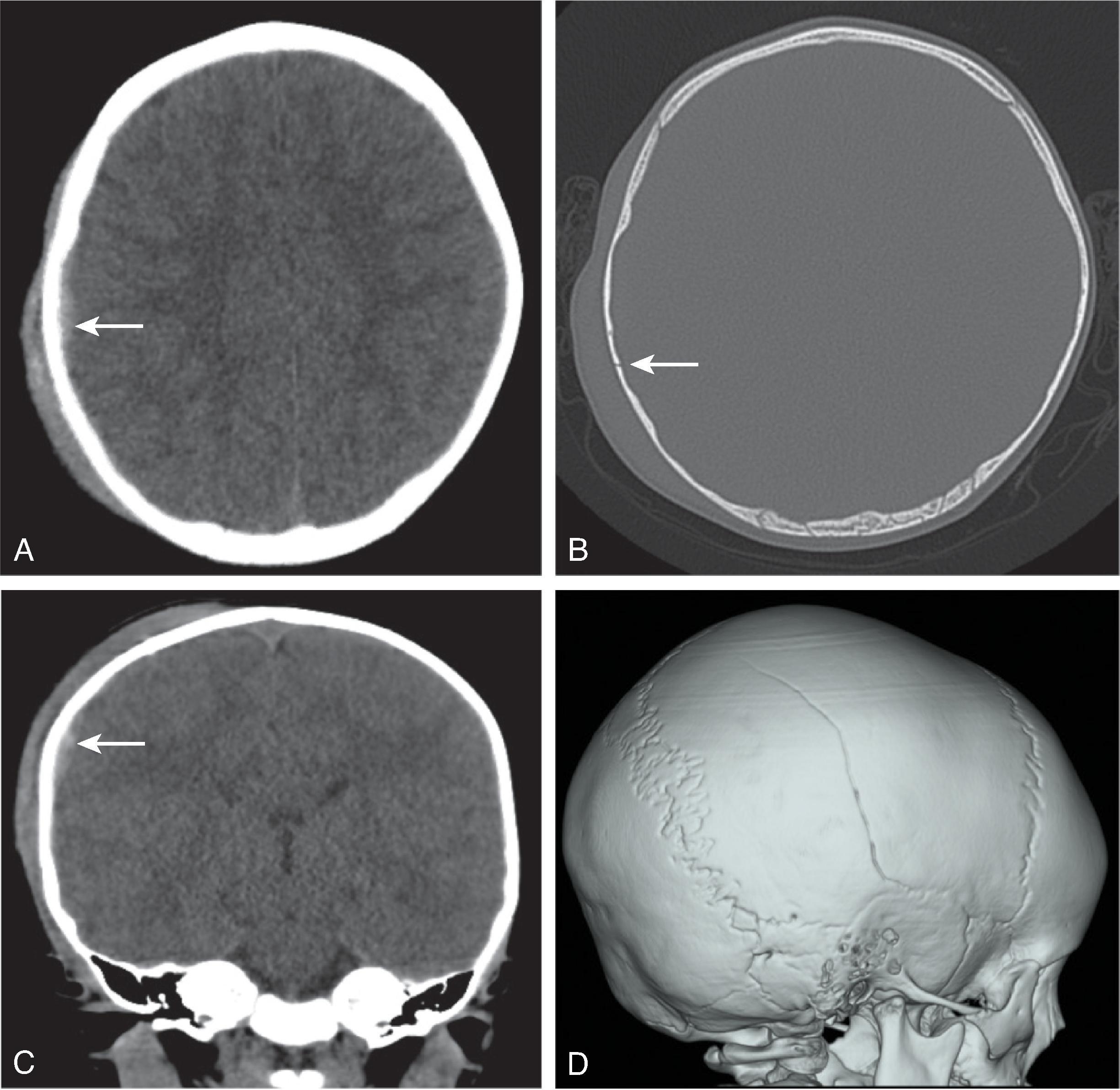 Fig. 10.9, Accidental Trauma . A 1-year-old with fall from high chair. (A and B) Axial head CT, (C) coronal head CT reformat, and (D) 3D volumetric CT images demonstrate and right parietal scalp subgaleal hematoma, a nondisplaced right parietal skull fracture ( arrow , image B), and a hyperdense/acute epidural hemorrhage ( arrow , images A and C) along the lateral right parietal lobe adjacent to the fracture.