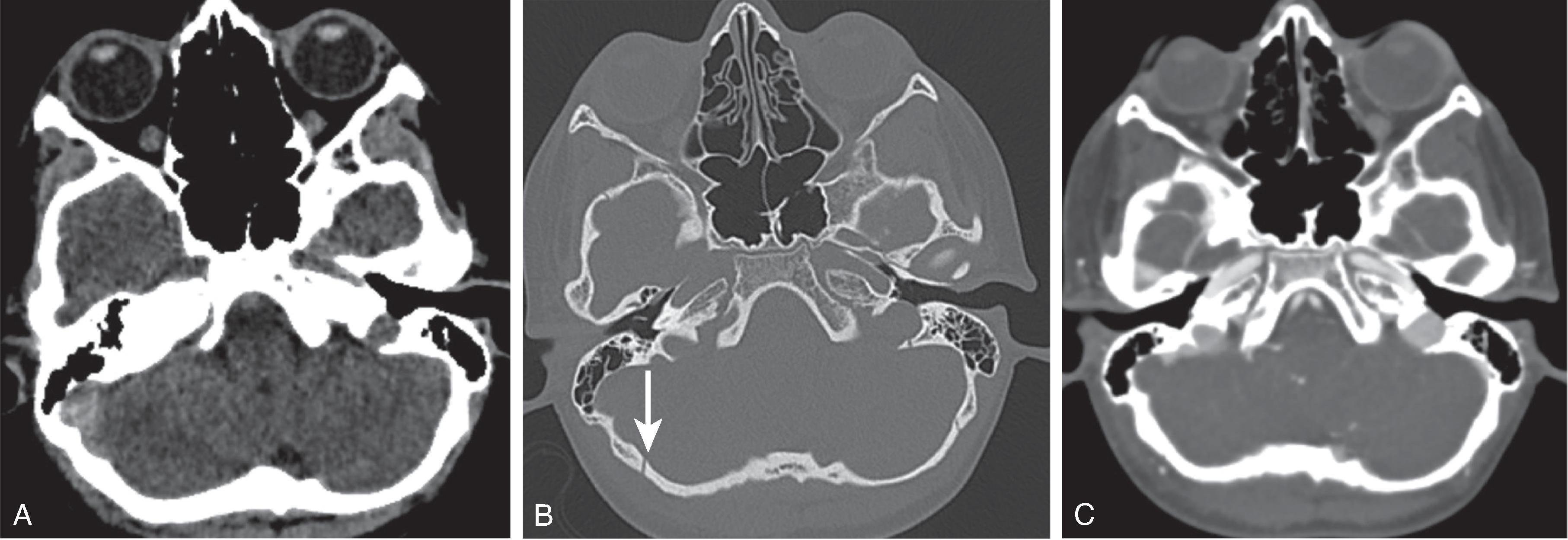 Fig. 10.10, Fracture-Related Dural Sinus Thrombus . A 13-year-old with backward fall onto concrete, subsequent vomiting, headache, and scalp swelling. (A) Axial head CT demonstrates a hyperdensity in the right sigmoid sinus. (B) Axial bone filter image demonstrates a subtle asymmetrically widened diastatic fracture of the right lambdoid suture ( arrow ). (C) Axial CT venogram demonstrates a filling defect with abrupt cutoff in the right sigmoid sinus due to thrombus.