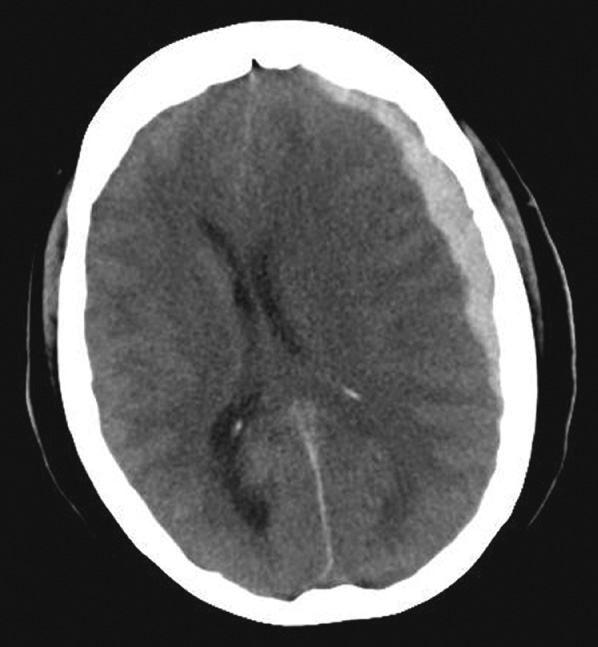 CT. Acute SDH overlying the left cerebral convexity with quite severe mass effect. *