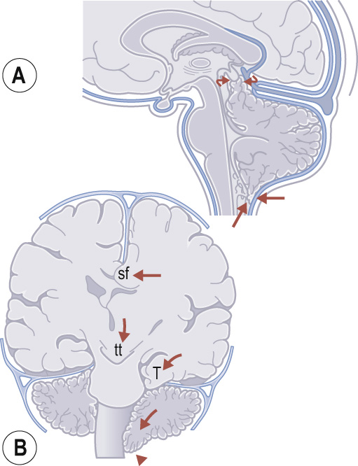 Herniations of the brain. (A) Cerebellar herniation with curved arrows demonstrating upward herniation of the superior cerebellum and superior vermis, with the straight arrows demonstrating tonsillar and inferior vermian herniation. (B) Temporal lobe herniation (T), central transtentorial herniation (tt), tonsillar herniation (arrowhead) and subfalcine herniation (sf). Lines of force are demonstrated by arrows.