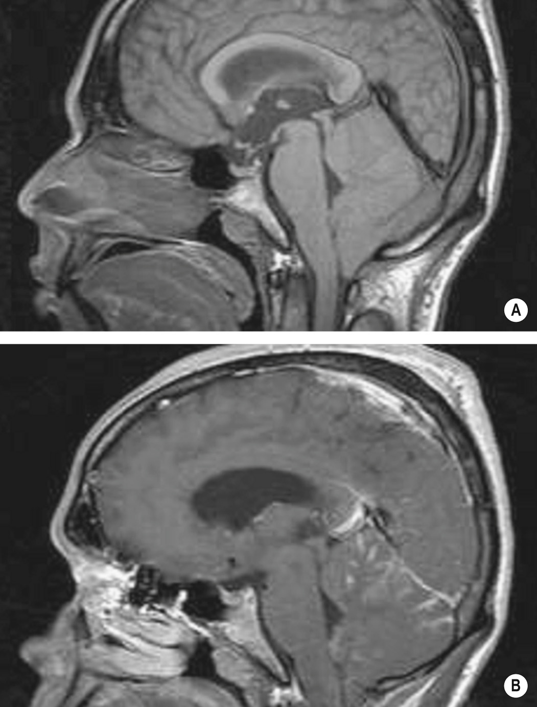 Tonsillar herniation (A) Sagittal T1WI shows pegged appearance of cerebellar tonsils through foramen magnum simulating a Chiari I malformation. (B) T1WI + Gad shows cerebellar leptomeningeal enhancement due to cryptococcal menginoencephalitis in this patient with AIDS. ++