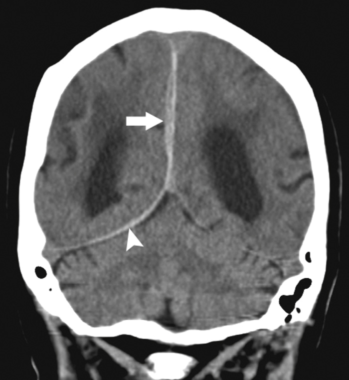 CT: Coronal reformatted image demonstrates a subtle parafalcine subdural haematoma (arrow) with layering over the tentorium cerebelli (arrowhead). Reformatted coronal images are useful for identifying the latter, which may be difficult to identify on axial images. **