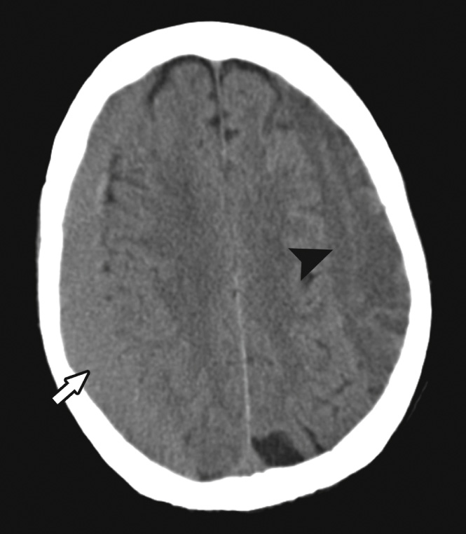 Bilateral subacute haematomas. CT: The subdural haematoma overlying the right cerebral convexity is isodense to brain parenchyma (arrow), and results in mass effect with effacement of the adjacent cortical sulci. The subdural collection overlying the left convexity (arrowhead) is of lower attenuation than brain parenchyma but denser than CSF, and is therefore older than that on the right side. **