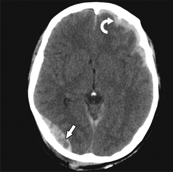 Trauma. CT: a biconvex extradural haematoma overlies the right parieto-occiptal region. Note the central low attenuation (arrow) within the haematoma, indicative of active haemorrhage. A crescent of fresh subdural blood is also seen overlying the left frontal and temporal lobes (curved arrow). **