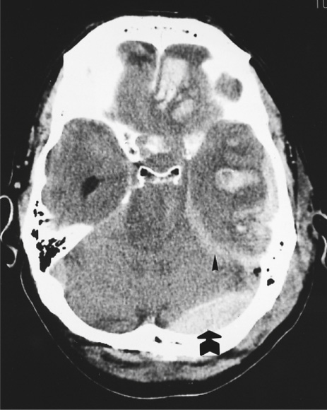 Trauma. CT: A biconvex density of blood over the left cerebellar hemisphere indicates an extradural haematoma (thick arrow). A crescent of fresh subdural blood spreads over the left temporal lobe and tracks along the tentorium in a comma-shaped fashion (arrowhead); this feature differentiates it from an extradural. Typical sites of haemorrhagic contusions are also seen; gyrus recti and temporal lobe. **