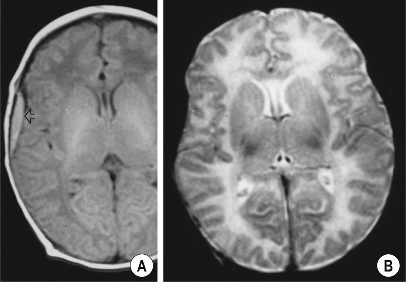 Acute extradural haematoma. MRI in a neonate with traumatic delivery. (A) Axial T1-weighted image (750/16). Slightly hyperintense epidural collection (arrow) in the right temporal region. (B) Axial T2 -weighted image (3000/120), epidural collection is hypointense and is invisible except for deformation of the underlying cortex. This is the MR signature of deoxyhaemoglobin. **