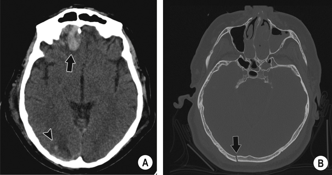 Contrecoup injury. (A) Haemorrhagic ‘contrecoup’ contusion is demonstrated within the anterior right frontal lobe (arrow). A ‘coup’ contusion of the occipital lobe resulting from the direct impact is also seen (arrowhead), adjacent to a fracture of the right occipital bone (B, arrow). **