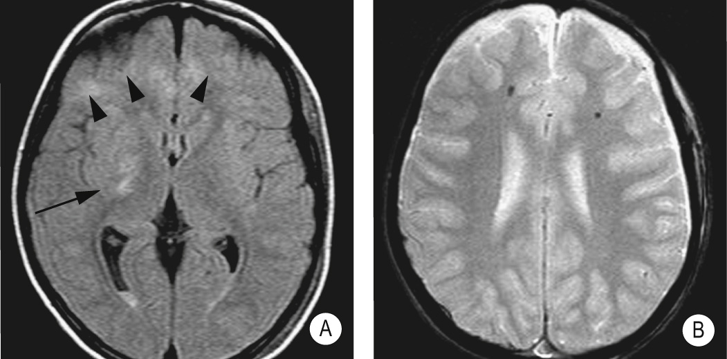 Diffuse axonal injury. (A) FLAIR high SI foci in the posterior limb of internal capsule (arrow) and subcortical white matter (arrowheads). (B) Gradient-echo low SI foci in subcortical white matter indicative of haemorrhages were not evident on other sequences. Note IVH in occipital horns of lateral ventricles. ++