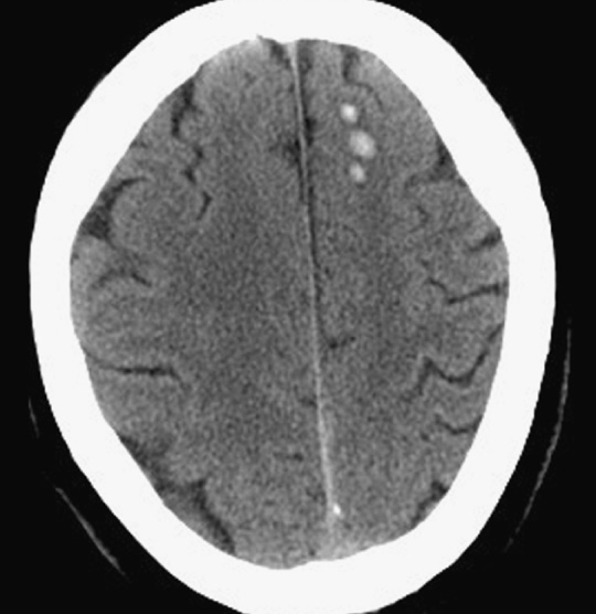 NECT. Shear haemorrhages of diffuse axonal injury in left superior frontal gyrus following blunt head trauma. ++