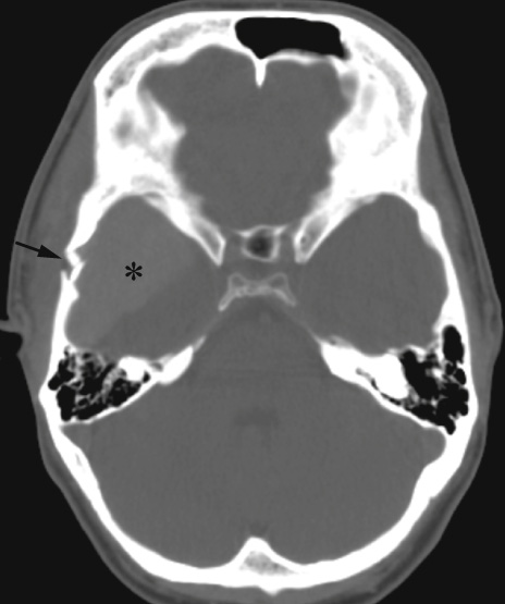 Right middle cranial fossa extra-axial haemorrhage (*) secondary to a fracture through the temporal bone (arrow).