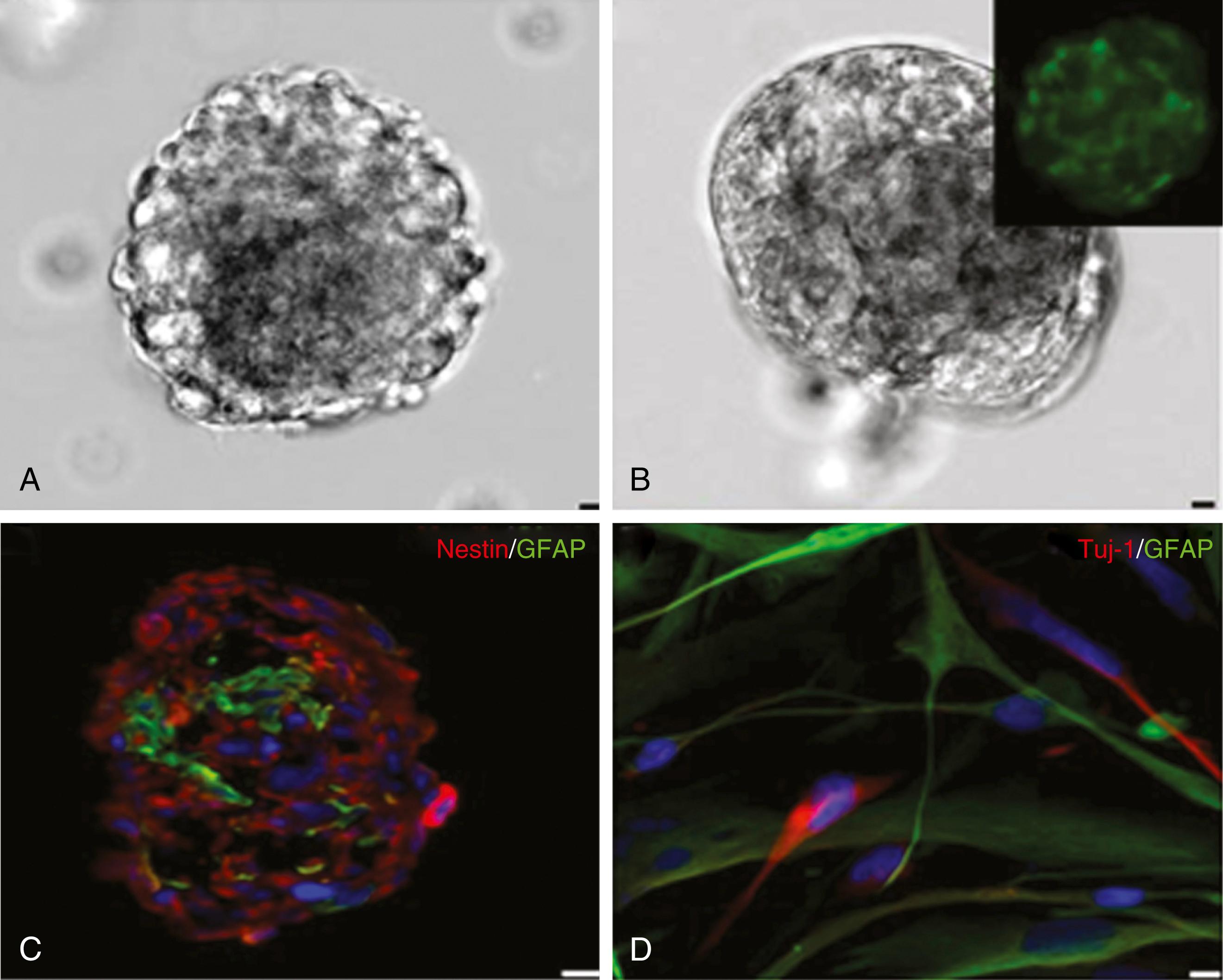 Figure 135.1, Light microscopy (A–B) and immunocytochemistry (C–D) photomicrographs of neurospheres derived from human purified astrocytes. Samples originated from glioblastoma multiforme (A) and the subventricular zone (B). (C) These neurospheres display the immature cell marker nestin (red) in the periphery and the astrocytic marker glial fibrillary acidic protein (GFAP) in the core (green). (D) After differentiation, neurospheres give rise to cells that express neuron (red) or astrocyte (green) markers (Tuj-1 and GFAP, respectively).