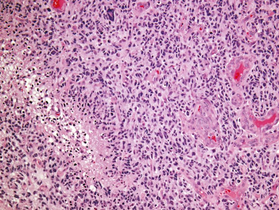 Figure 133.1, Glioblastoma.