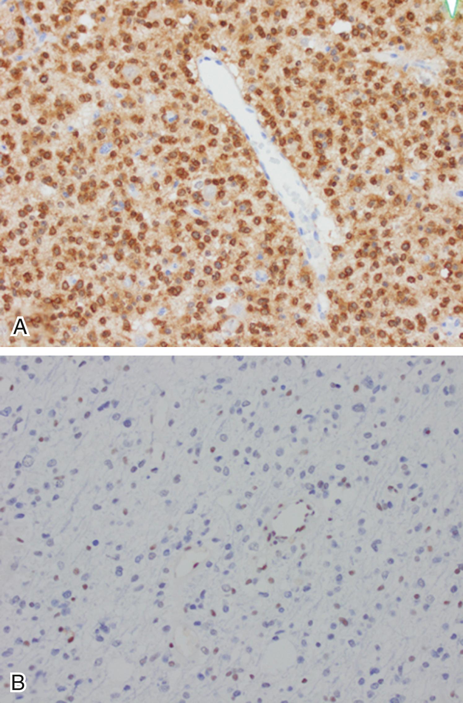 Figure 133.2, Astrocytoma.