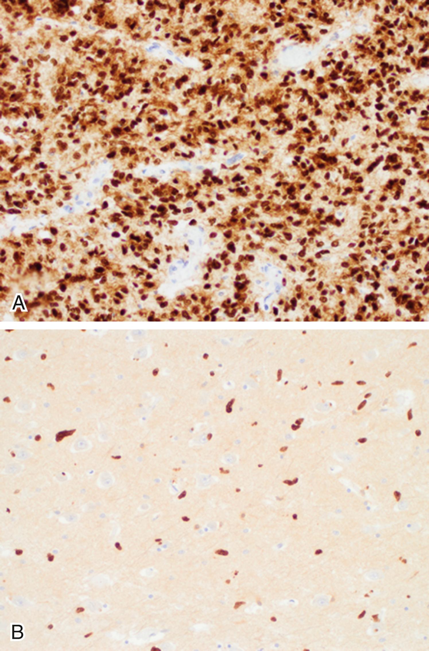 Figure 133.3, Diffuse midline glioma, H3-K27M mutant.