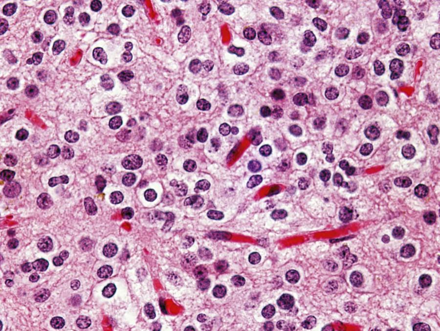 Figure 133.4, Oligodendroglioma.