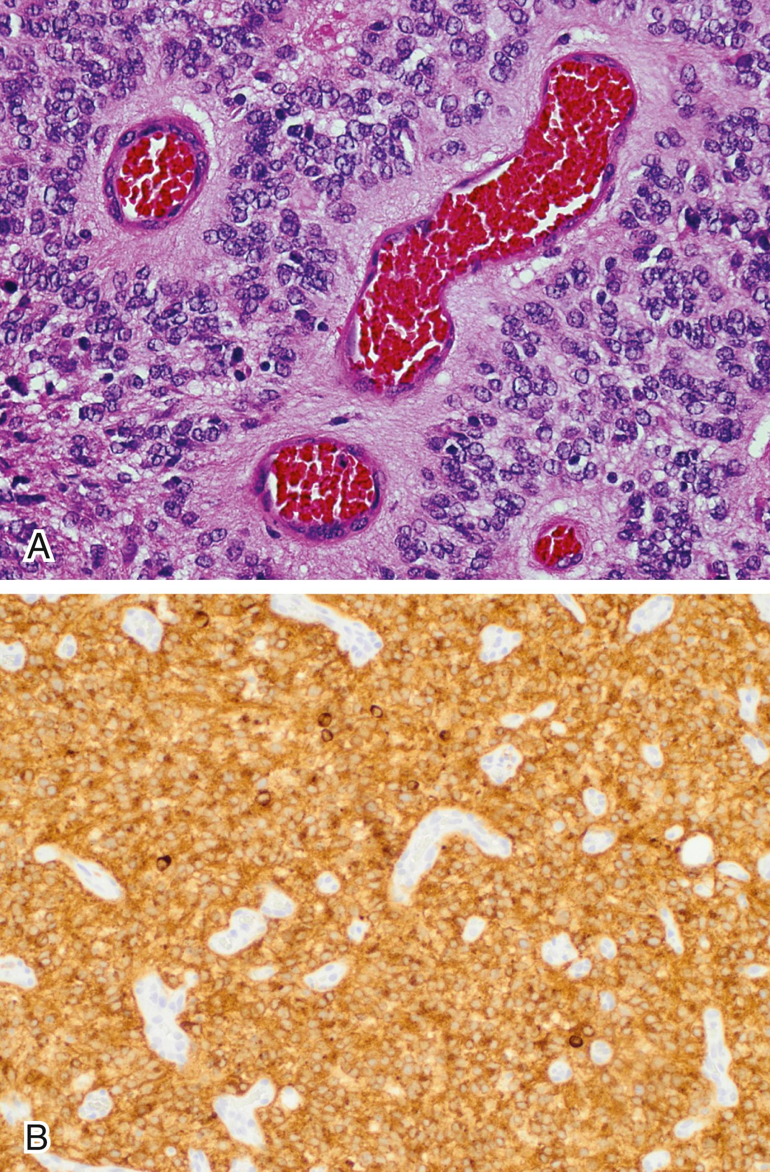 Figure 133.5, Ependymoma.