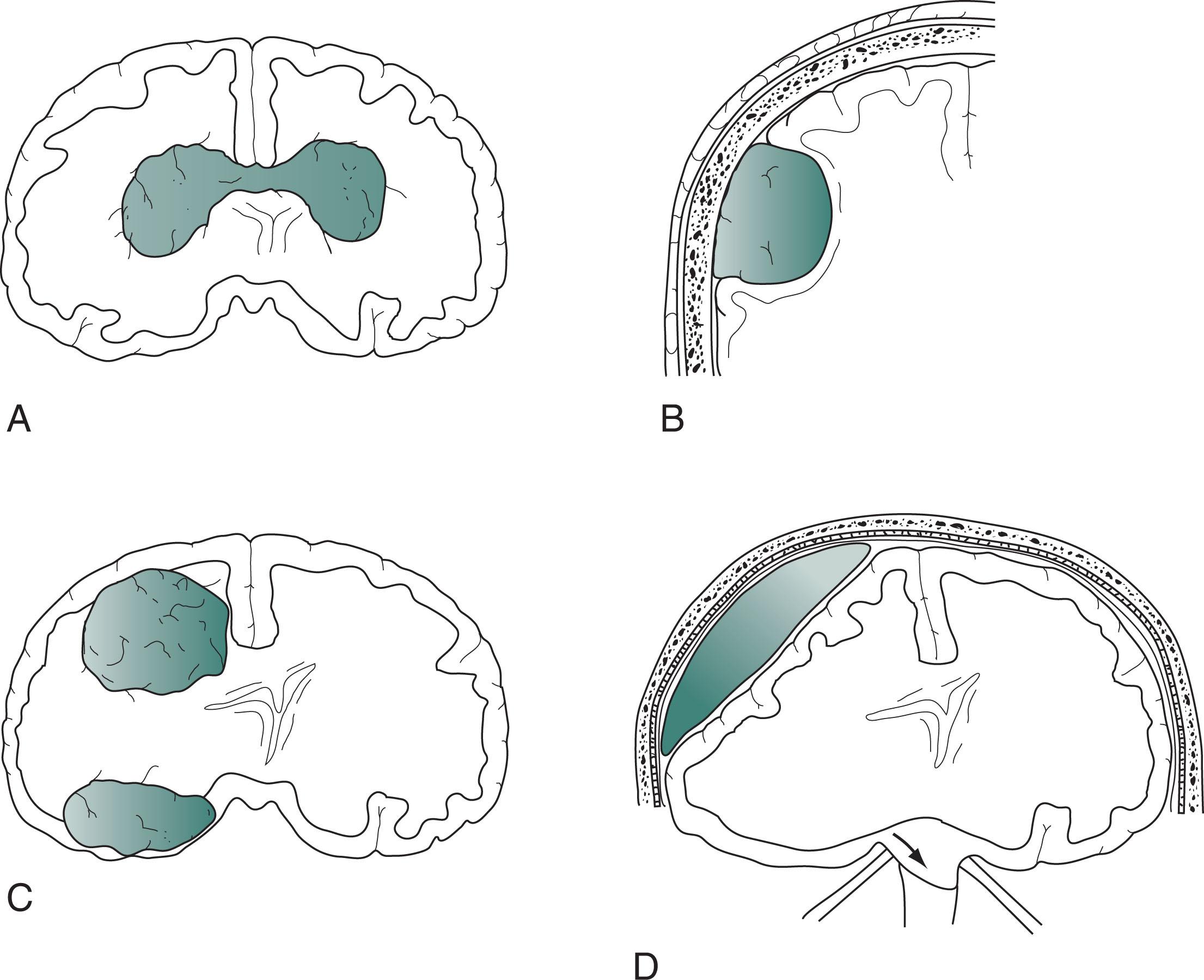 Fig. 19.1, (A) A glioblastoma , in this sketch, arose in one frontal lobe and spread through the corpus callosum to infiltrate the other frontal lobe, producing the classic “butterfly” pattern (see Figs. 20.8 and 20.20 ). (B) This tumor, a meningioma , arose from the meninges, grew slowly, and compressed but did not infiltrate the underlying brain (see Fig. 20.10 ). (C) Metastatic tumors have destroyed large areas of brain and raised intracranial pressure (see Fig. 20.8 ). (D) A subdural hematoma located over one cerebral hemisphere has compressed the underlying brain and ventricles and pushed away (shifted) midline structures (see Fig. 20.9 ).