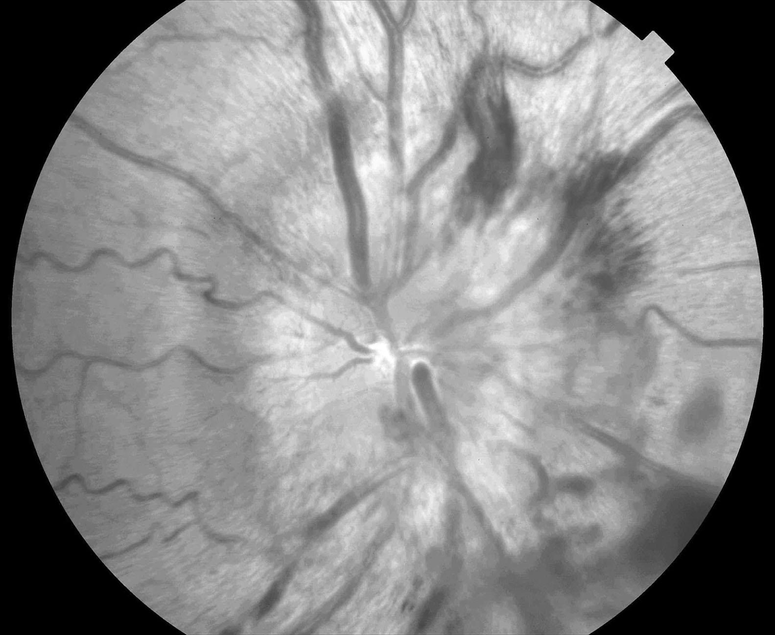 Fig. 19.2, The main features of papilledema are elevation and reddening of the optic disk, loss of its margins, and distention of the retinal veins. When papilledema is acute and severe—as in this picture—hemorrhages appear at the disk’s margin. Compare this disk to a normal one ( Fig. 4.4 ) and one with less severe papilledema ( Chapter 9 , Question 72).