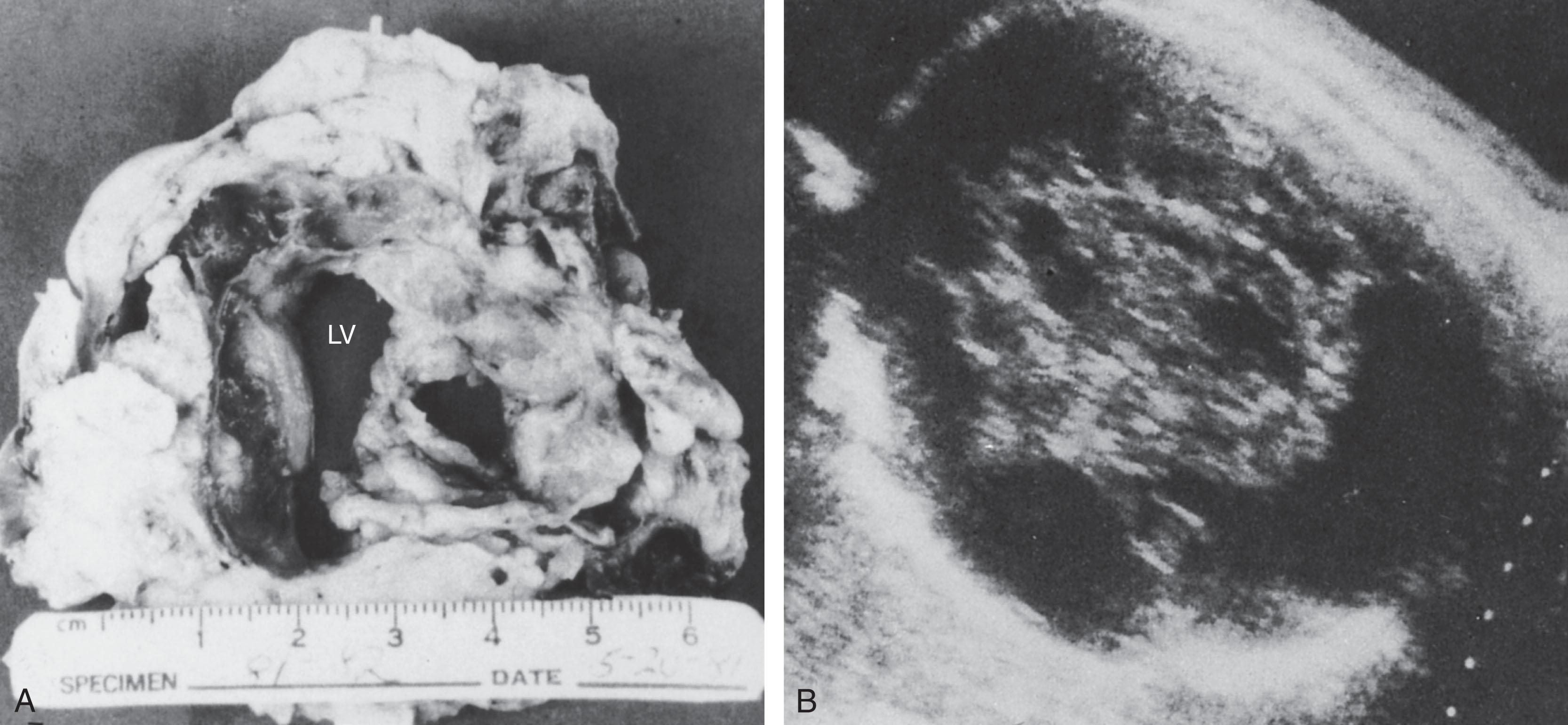 Fig. 41.1, Intracranial teratoma: gross neuropathology.