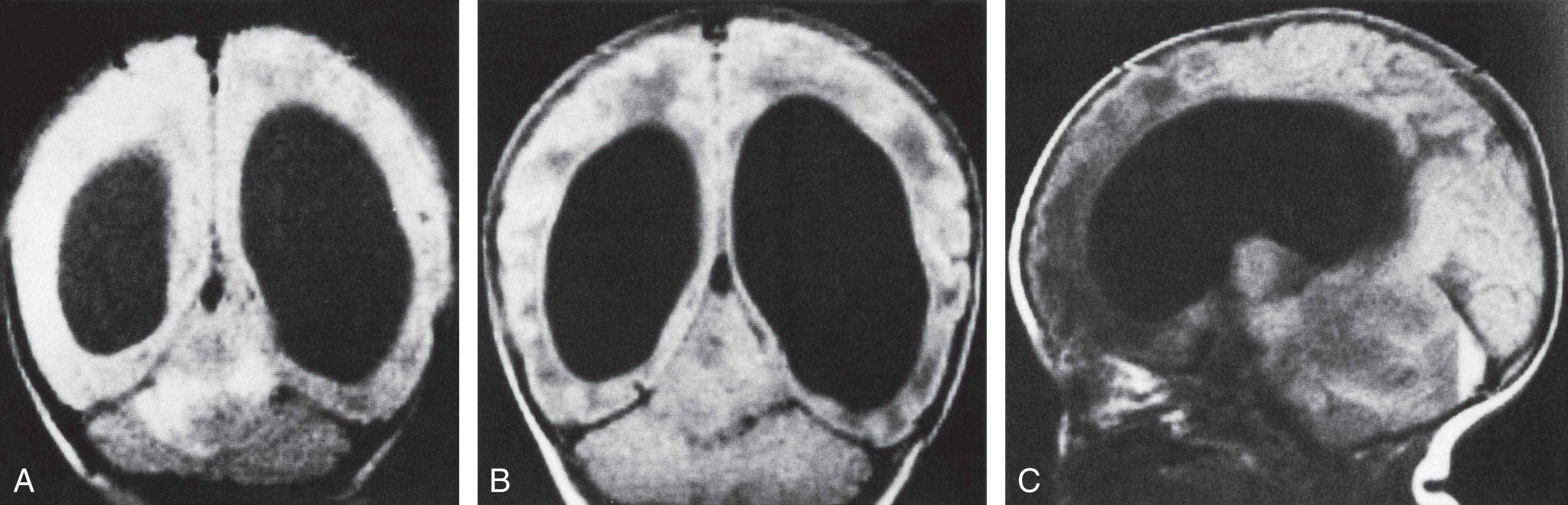 Fig. 41.12, Medulloblastoma in a 49-day-old infant: magnetic resonance imaging (MRI) scans.