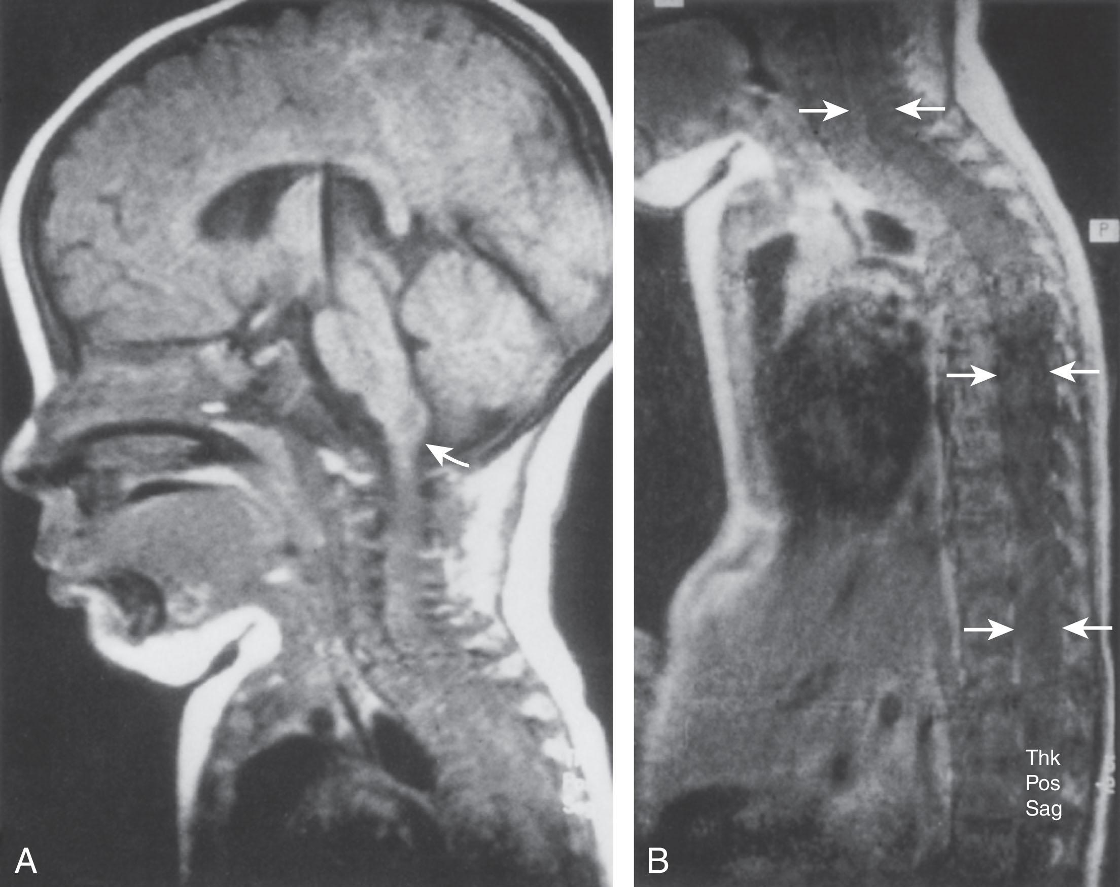 Fig. 41.14, Spinal cord and medullary astrocytoma: magnetic resonance imaging (MRI) scan.