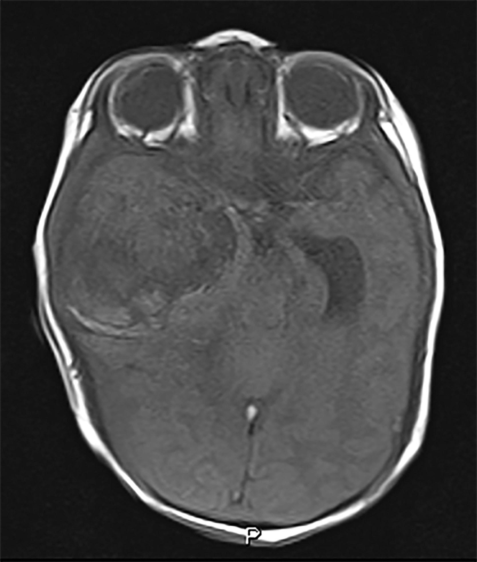 Fig. 41.2, Infant-type hemispheric glioma.