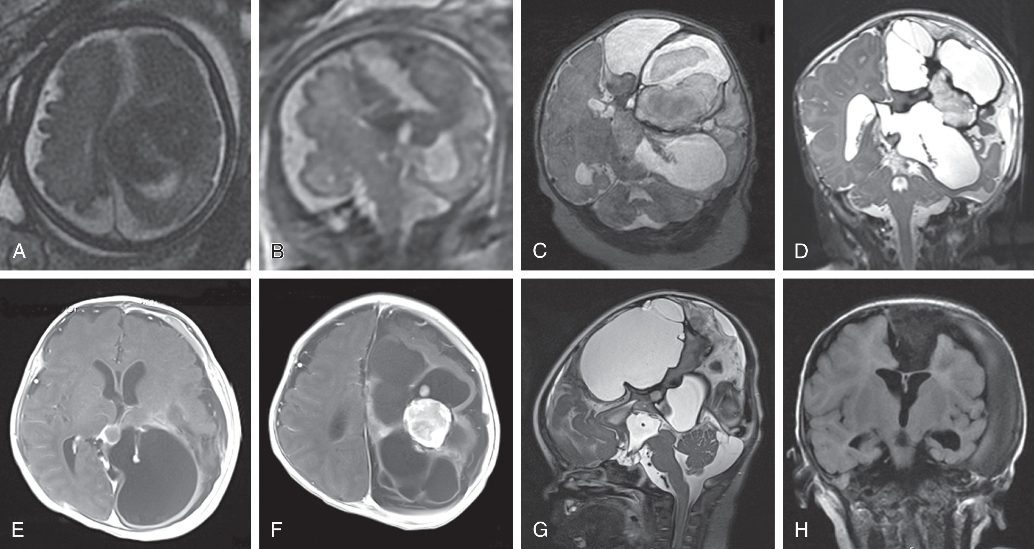 Fig. 41.3, Low-grade (World Health Organization grade I) glioneuronal tumor that was initially considered a high-grade glioma based on fetal and newborn magnetic resonance imaging (MRI) and consistent with desmoplastic infantile ganglioglioma (see text).