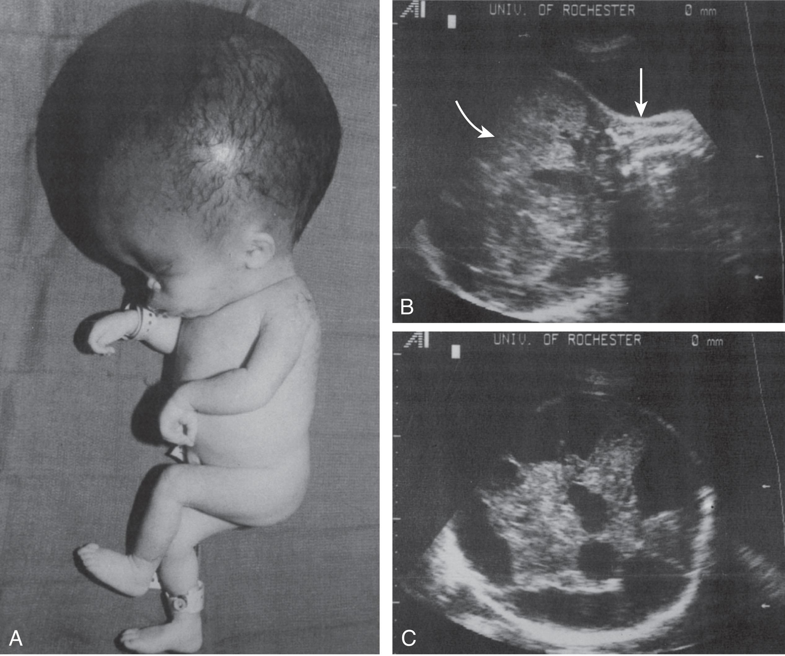 Fig. 41.4, Teratoma with intrauterine presentation.