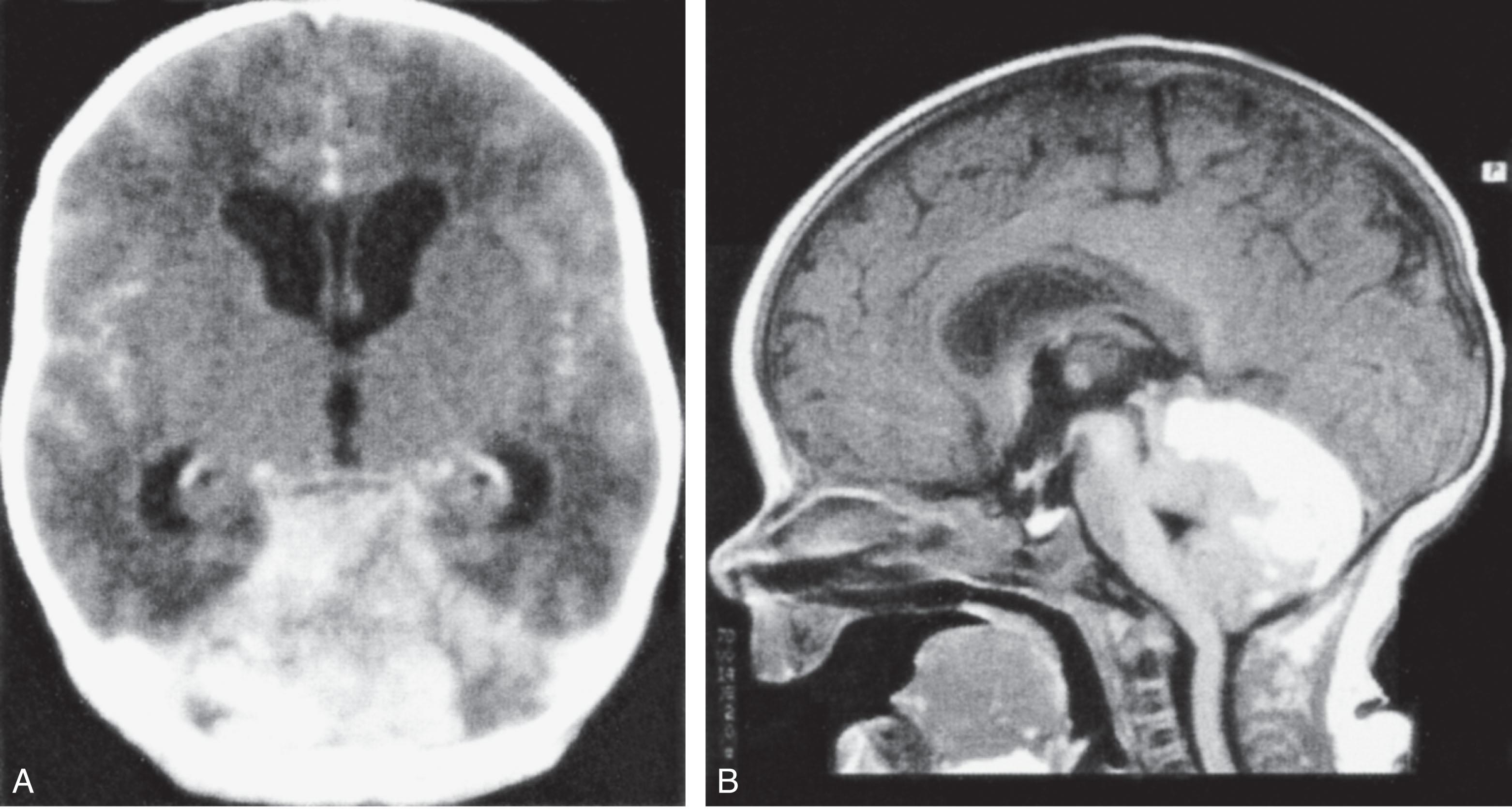 Fig. 41.6, Posterior fossa hemorrhage in a newborn with a medulloblastoma.