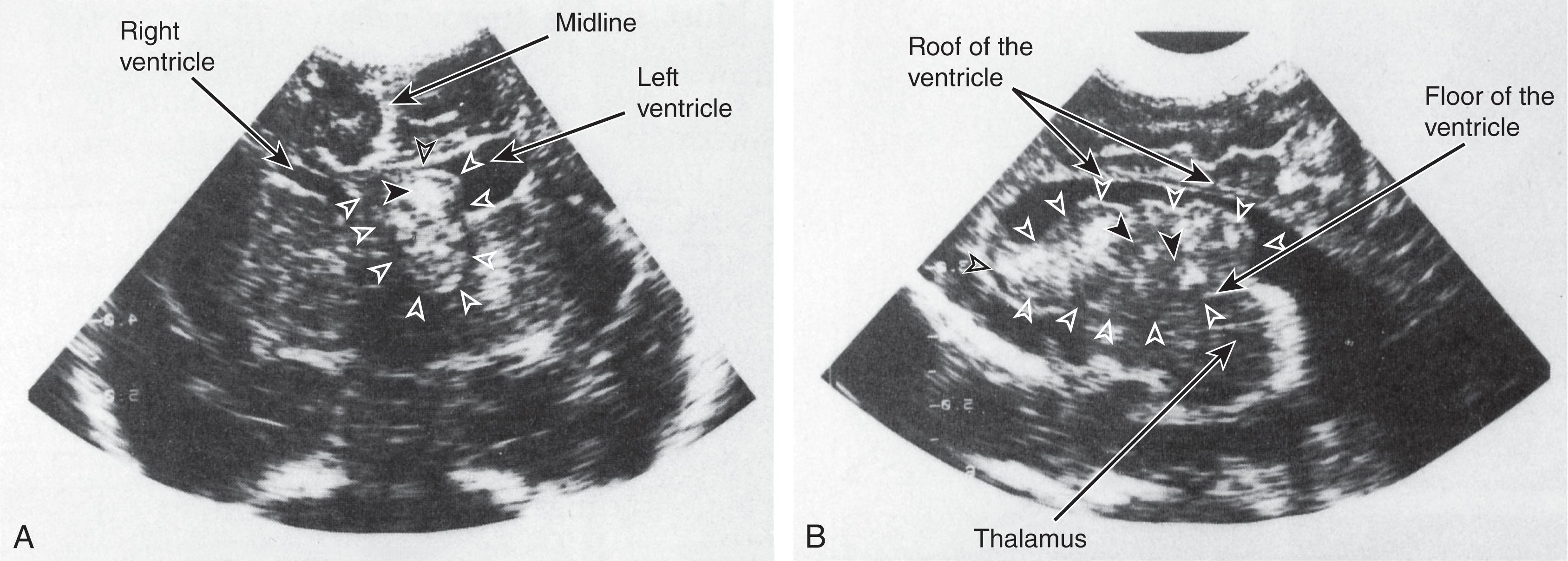 Fig. 41.7, Cranial ultrasonography: neonatal subependymal astrocytoma.