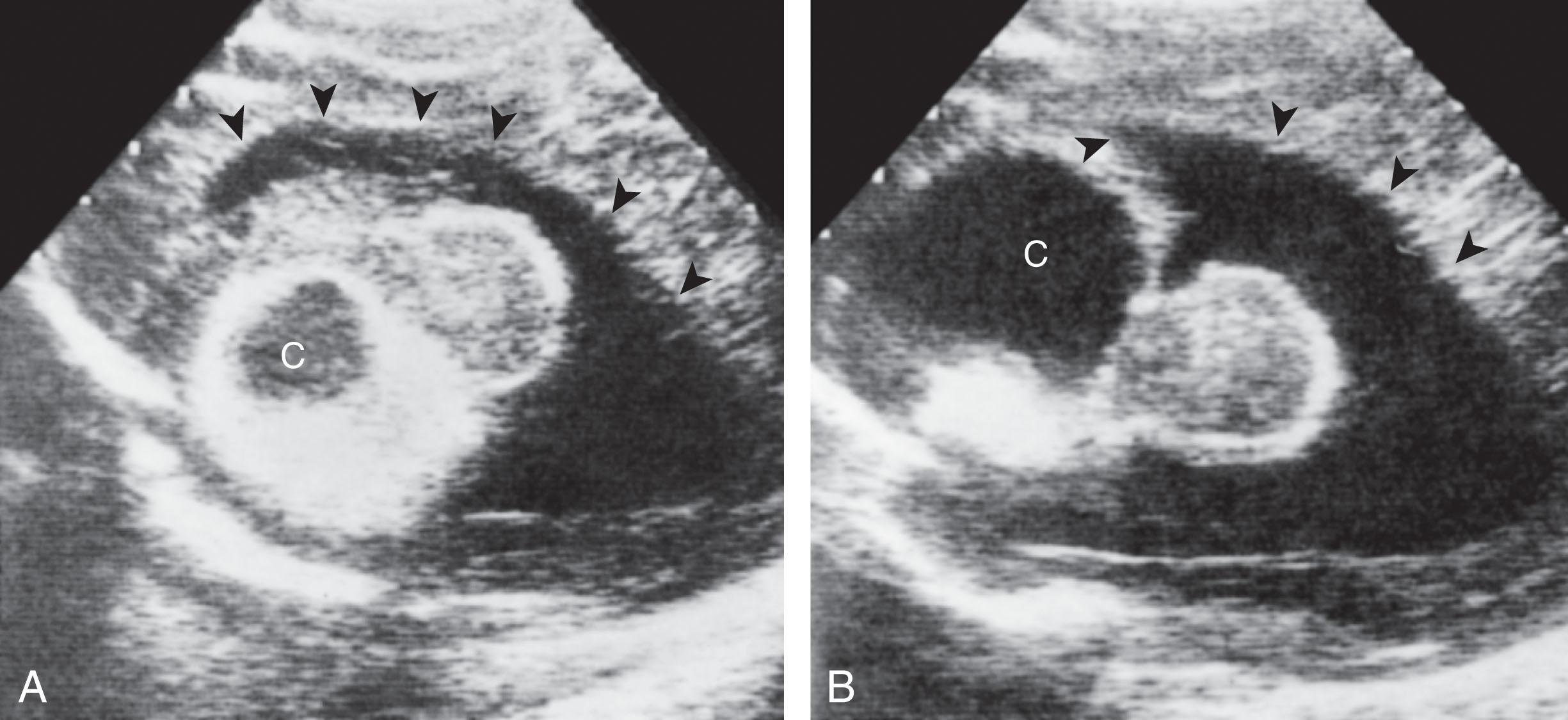 Fig. 41.8, Cranial ultrasonography: neonatal craniopharyngioma.