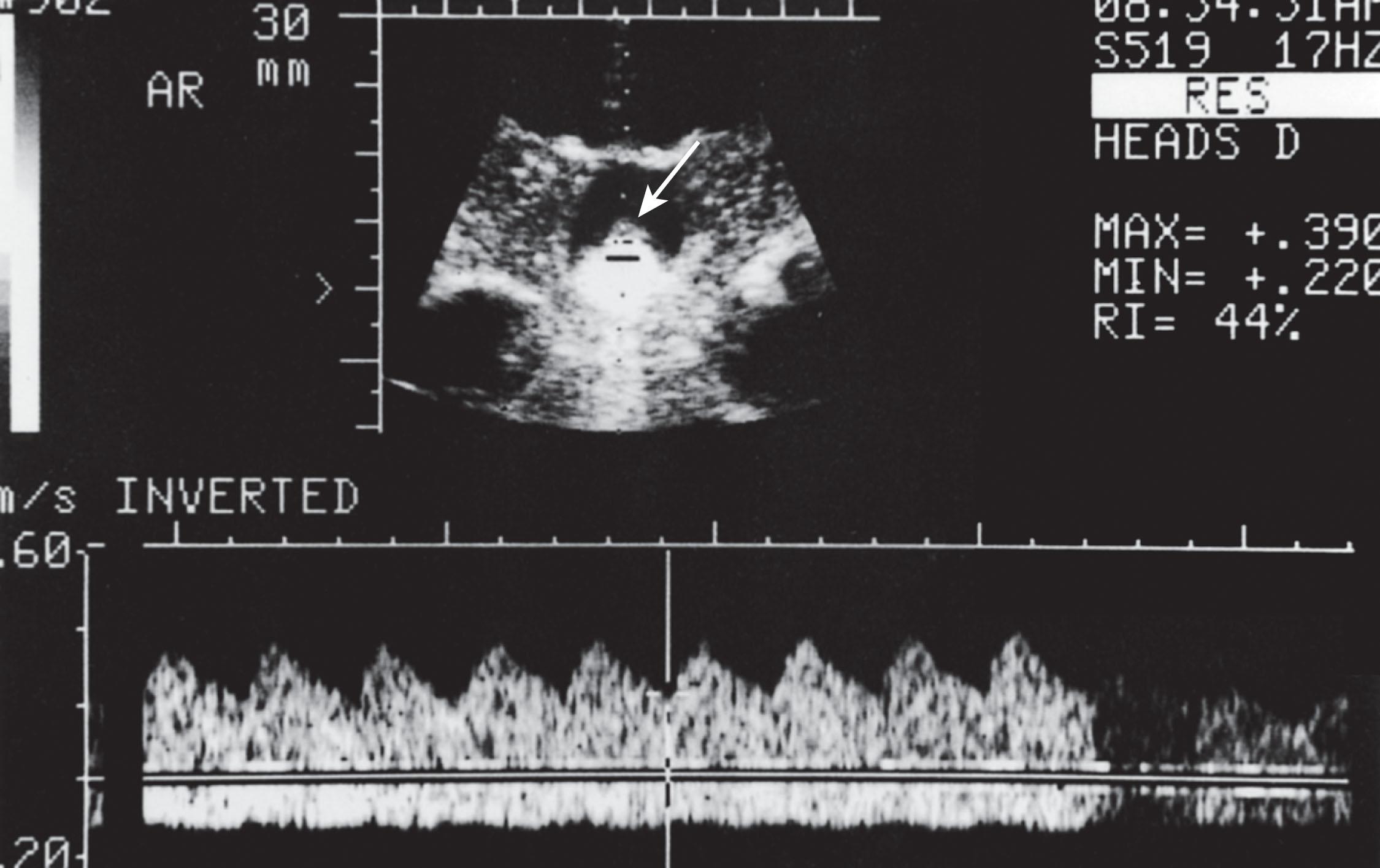 Fig. 41.9, Cranial Doppler and ultrasonographic study of choroid plexus papilloma.