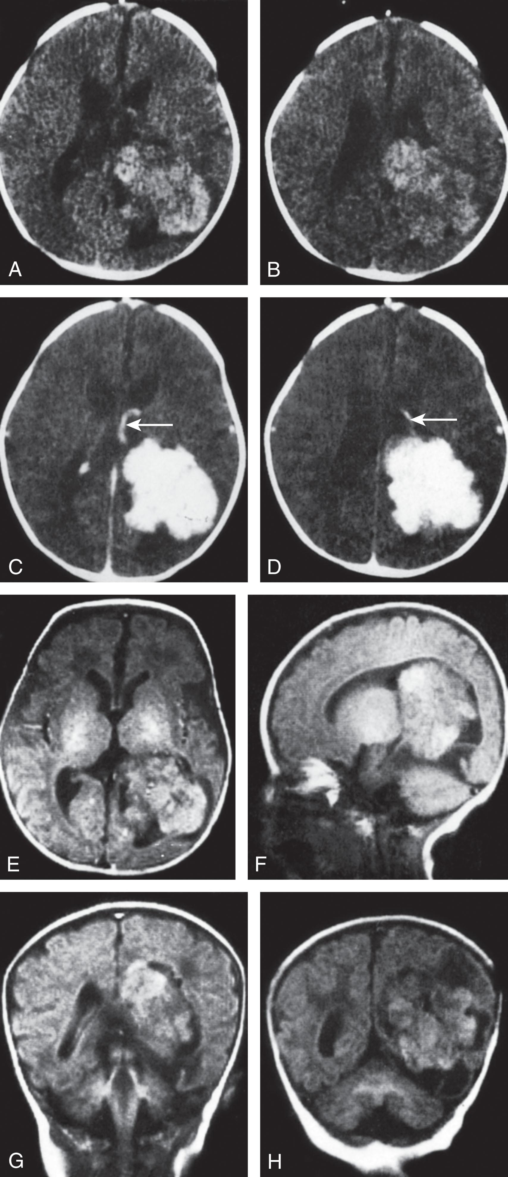 Fig. 41.10, Choroid plexus papilloma: computed tomography (CT) and magnetic resonance imaging (MRI) scans from an 11-day-old infant with macrocrania.