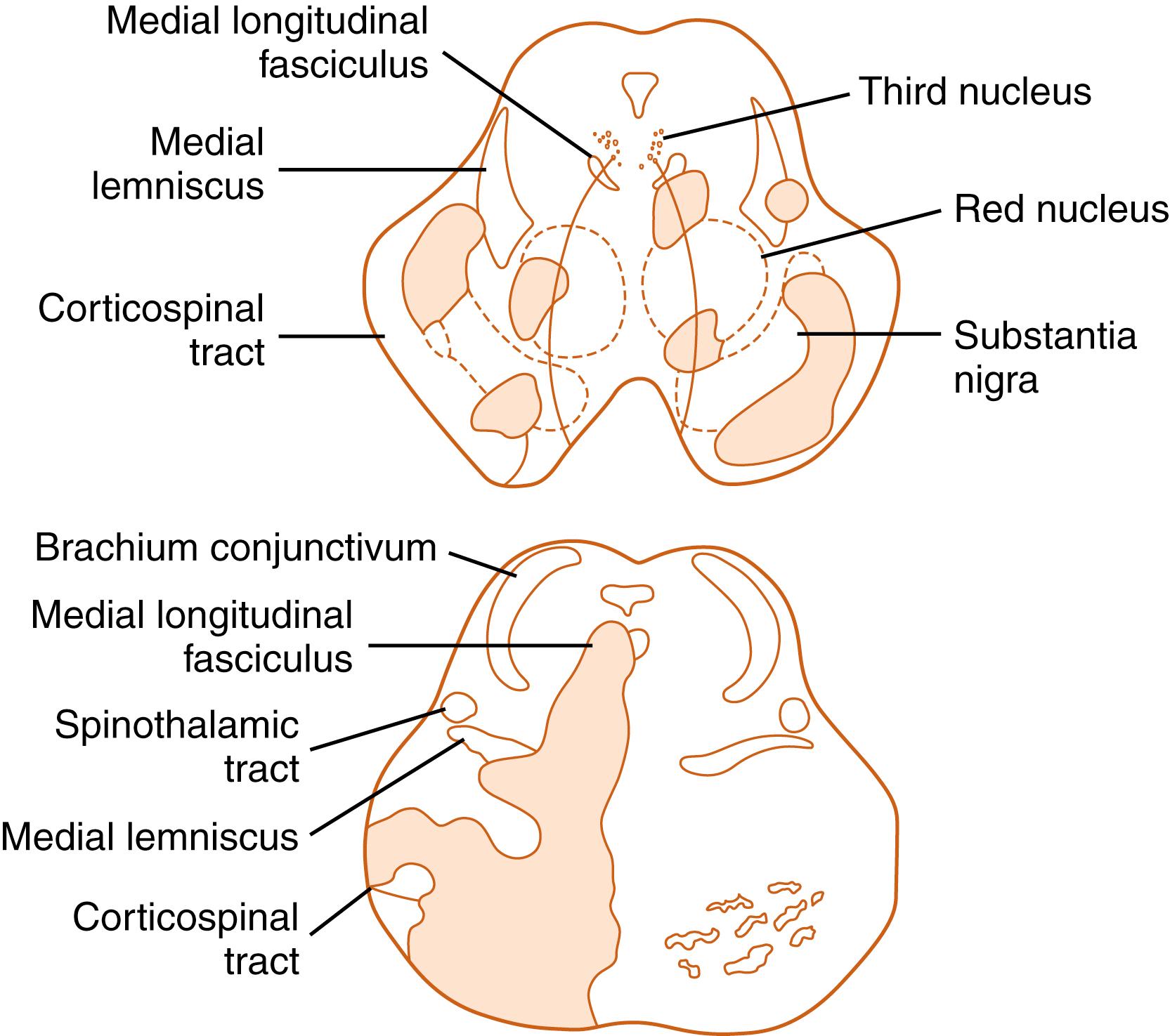 Fig. 21.1, Distribution of Brainstem Infarction in a Patient with Basilar Artery Embolism.