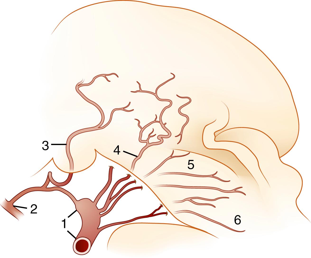 Fig. 21.2, Branches of the basilar communicating artery (P1 segment of posterior cerebral artery), as seen in a sagittal section of the brainstem: thalamic polar (1) , posterior communicating (2) , posterior thalamosubthalamic paramedian (3) , superior paramedian (4) , inferior paramedian (5) , and mesencephalic paramedian (6) .