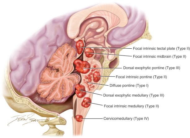 Figure 5.1, The various locations of brainstem tumors: focal intrinsic tectal plate; focal intrinsic midbrain; focal intrinsic pontine; dorsal exophytic pontine; diffuse pontine; focal intrinsic medullary; dorsal exophytic medullary.