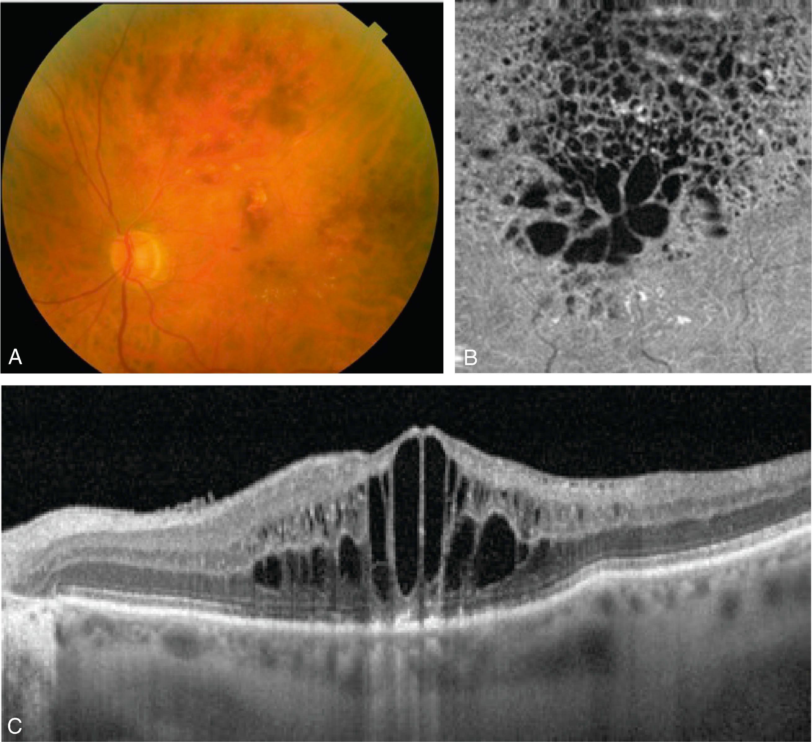 branch retinal vein occlusion icd 10
