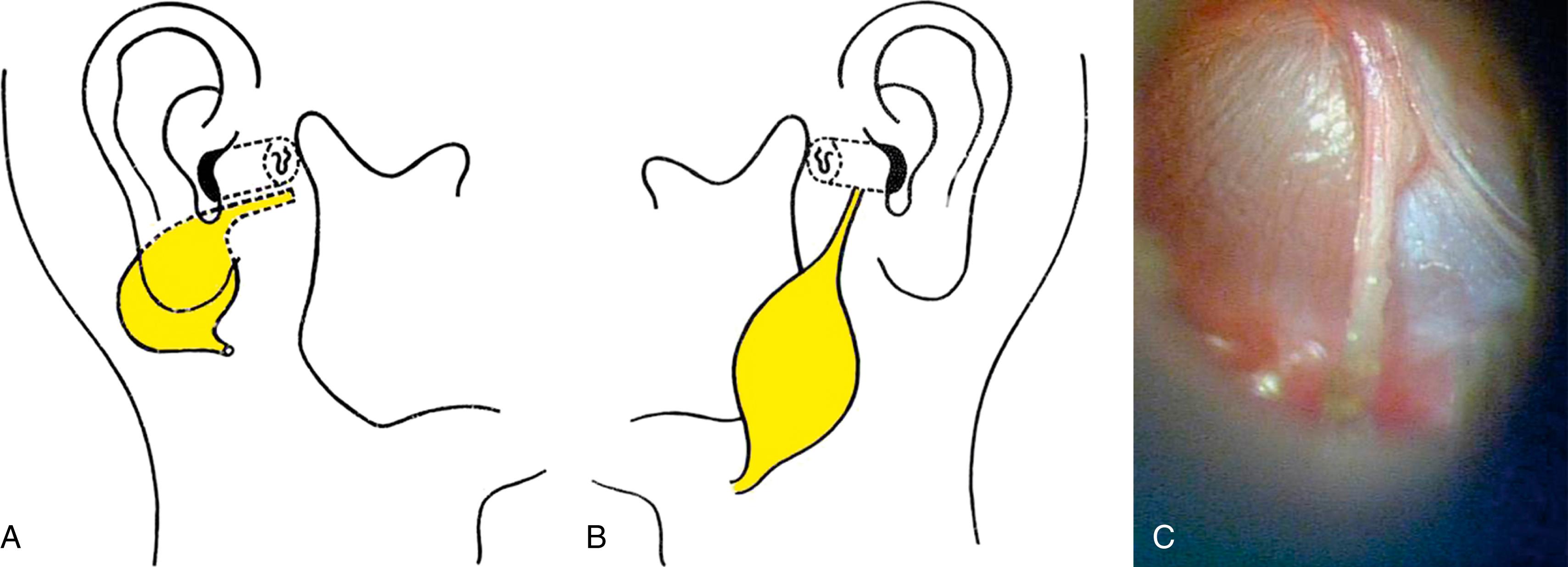 Fig. 201.2, A, Type I first branchial anomaly. B, Type II first branchial anomaly. C, Extension of a type II first branchial anomaly to the tympanic membrane.