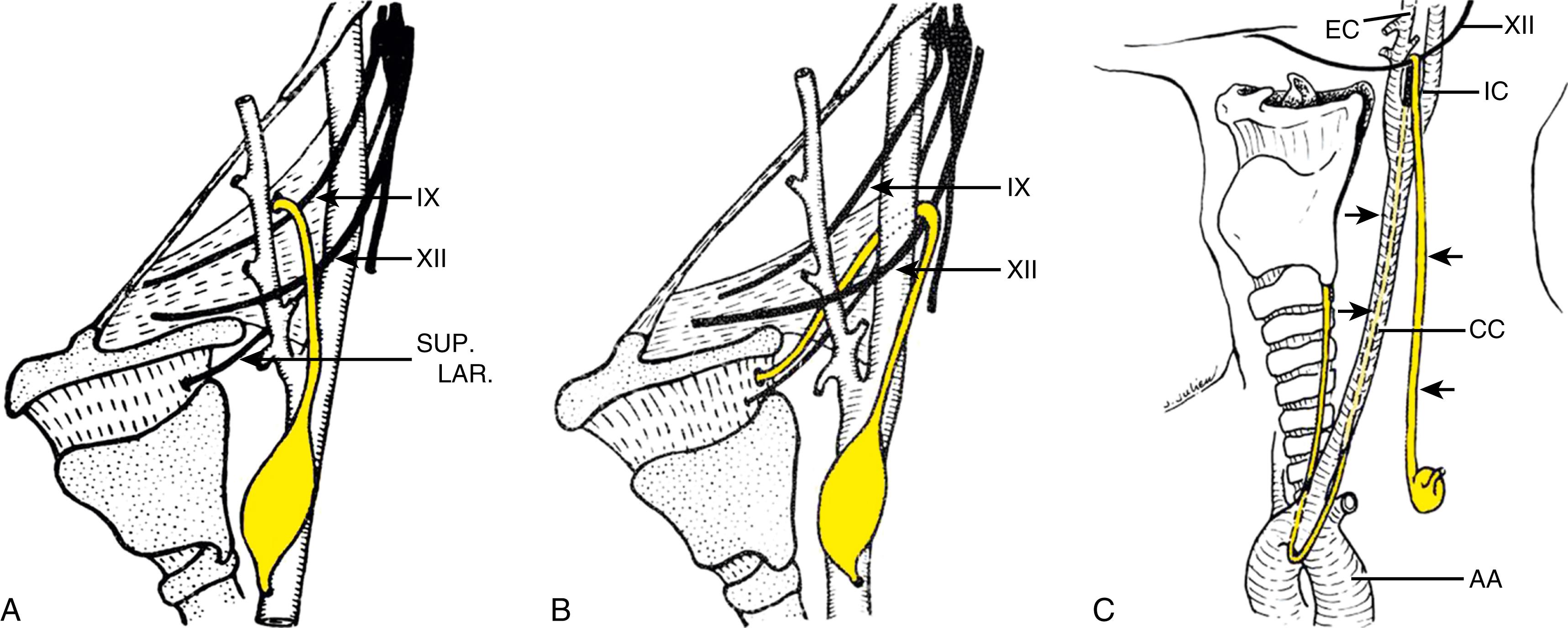 Fig. 201.3, A, Second branchial anomaly. B, Third branchial anomaly. C, Fourth branchial anomaly. IX - Glossopharyngeal Nerve, XII - Hypopharyngeal Nerve, Sup. Lar. - Superior Laryngeal Nerve, EC - External Carotid Artery, IC - Internal Carotid Artery, CC - Common Carotid Artery.