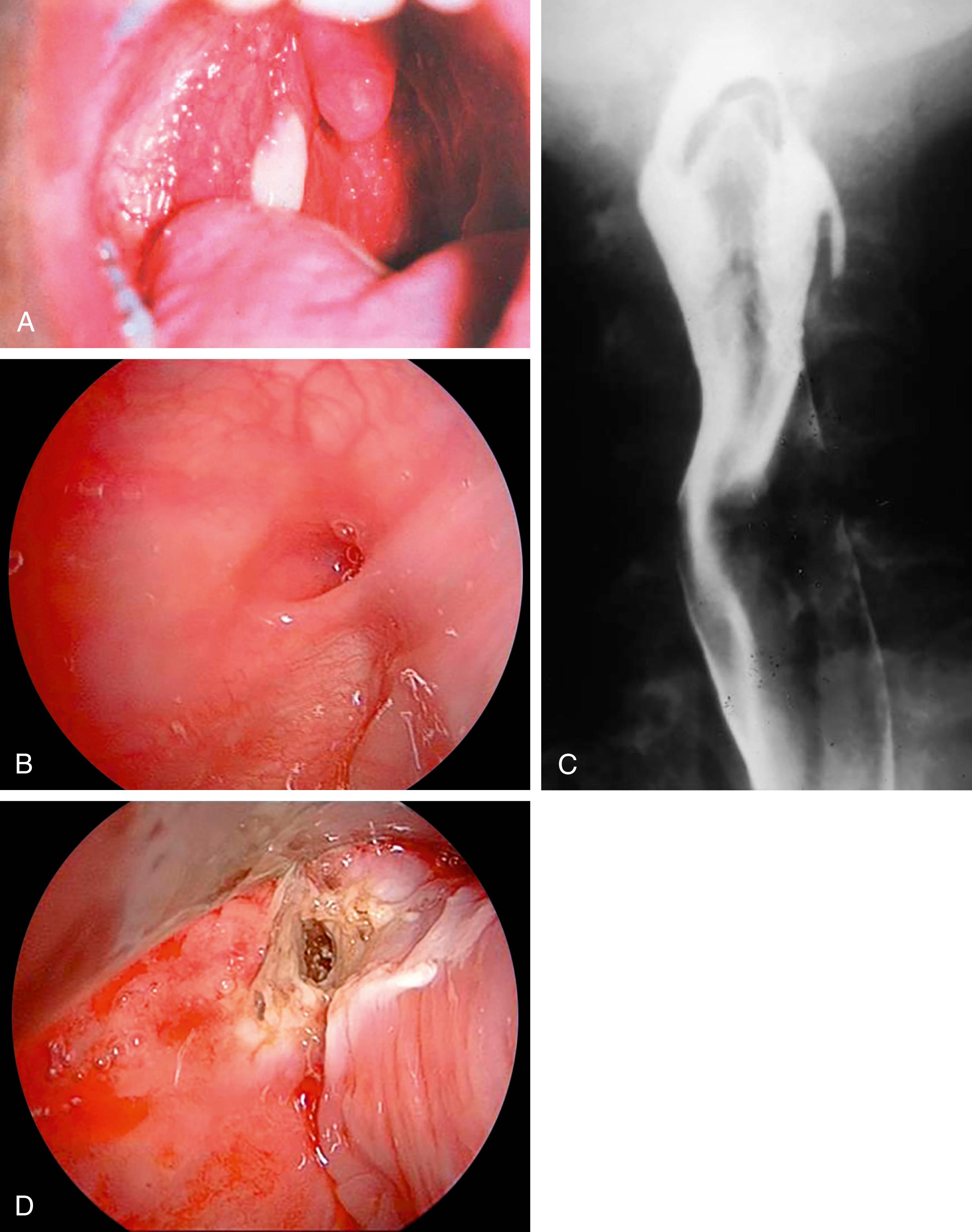 Fig. 201.4, A, Sinus opening within the tonsillar fossa. B, Sinus opening at the apex of the pyriform sinus. C, Contrast swallow study revealing a communication from the left pyriform sinus into the neck. D, Cauterization of pyriform sinus opening.