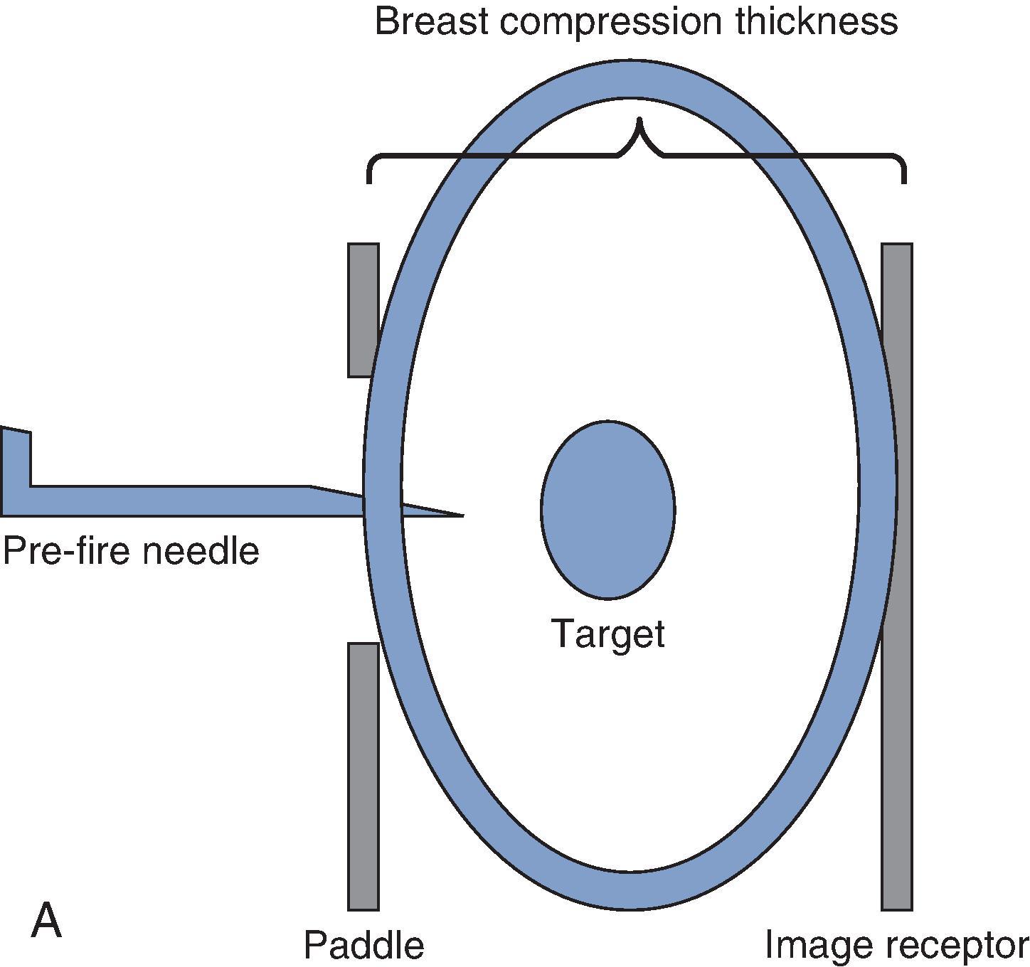FIG. 1, Successful pre-fire positioning to target the lesion, with the needle near the lesion. ( B from Ikeda DM : Breast imaging: The Requisites. 2nd ed. Elsevier; 2011.)