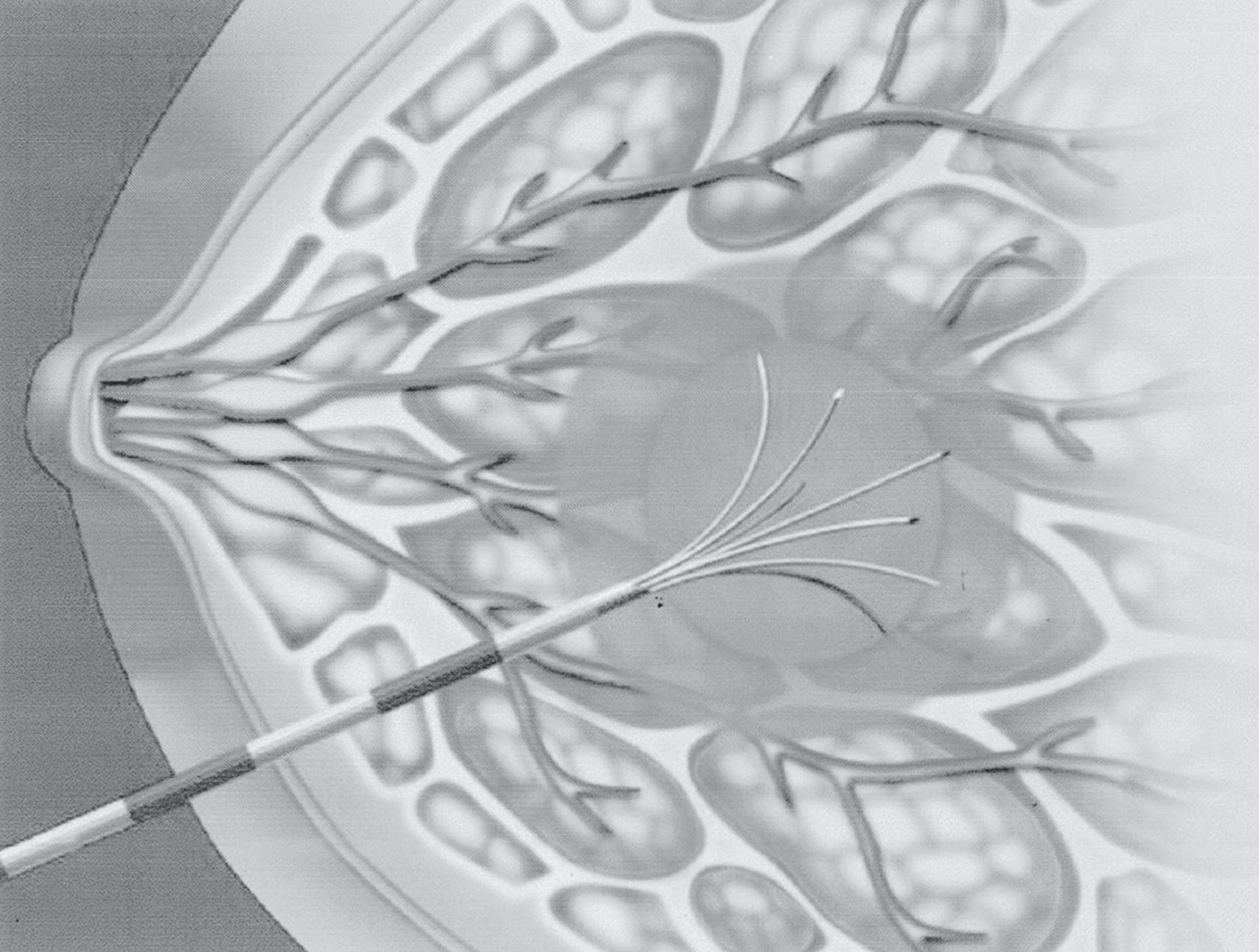 FIG. 1, Radiofrequency ablation showing star array probe with breast and surrounding frozen ablation zone. (Courtesy RITA Medical Systems. From Simmons R. Ablative techniques in the treatment of benign and malignant breast disease. J Am Coll Surg . 2003;197:334–338.)