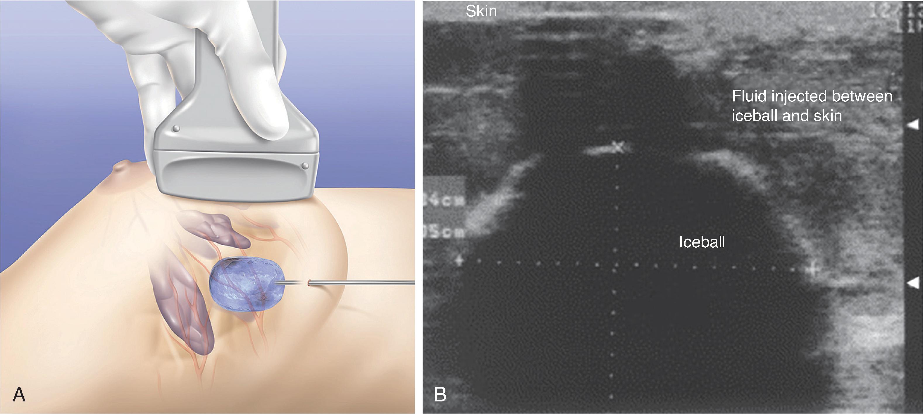 FIG. 2, (A) Ultrasonography is used to monitor the developing cryogenic zone created by the cryoprobe. (B) Ultrasound image of hypoechoic ice ball and protective saline injection. ( A from Kaufman C, Littrup P, Freman-Gibb L, et al. Office-based cryoablation of breast fibroadenomas: 12 month follow-up. J Am Coll Surg. 2004;198:914–923; B from Kaufman C, Bachman B, Littrup P, et al. Office-based ultrasound-guided cryoablation of breast fibroadenomas. Am J Surg. 2002;184:394–400.)