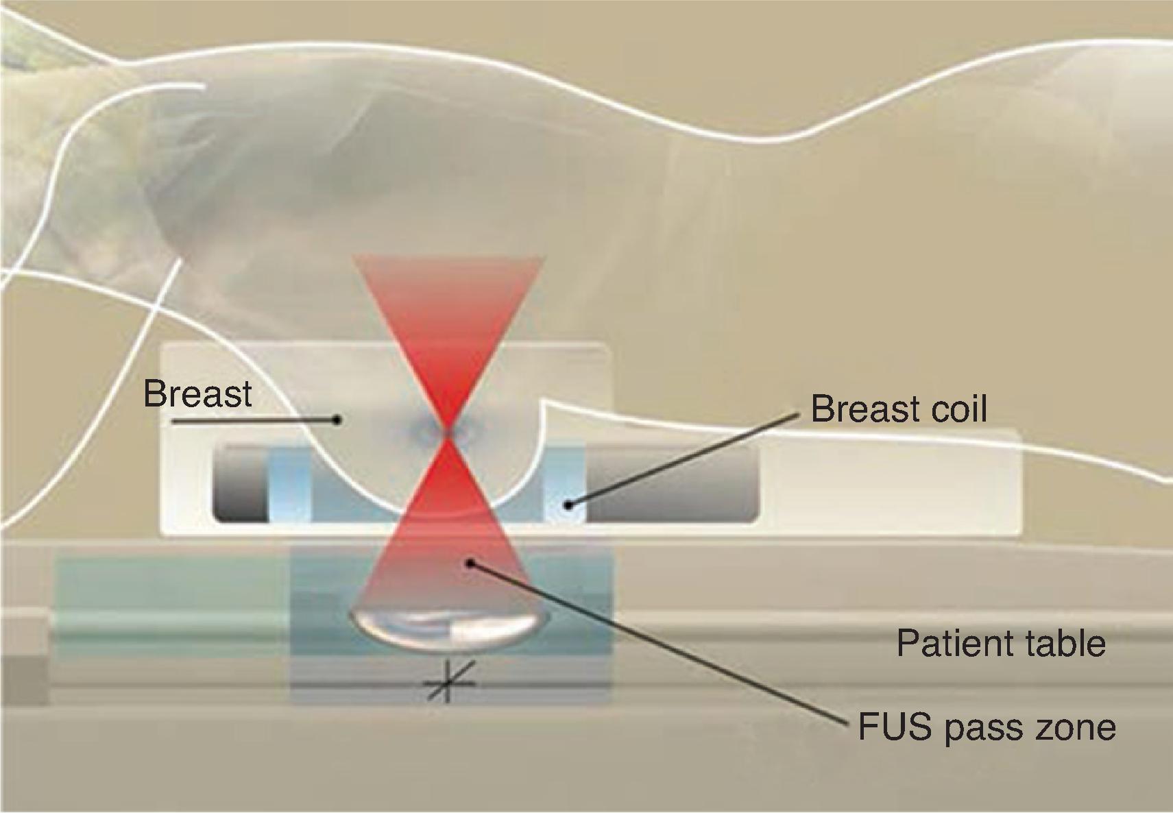 FIG. 3, MRI-guided high-intensity focused ultrasound (FUS) therapy for a breast cancer patient in prone position. (From Zhou Y. Noninvasive treatment of breast cancer using high-intensity focused ultrasound. J Med Imaging & Health Inform . 2013;3:141–156.)