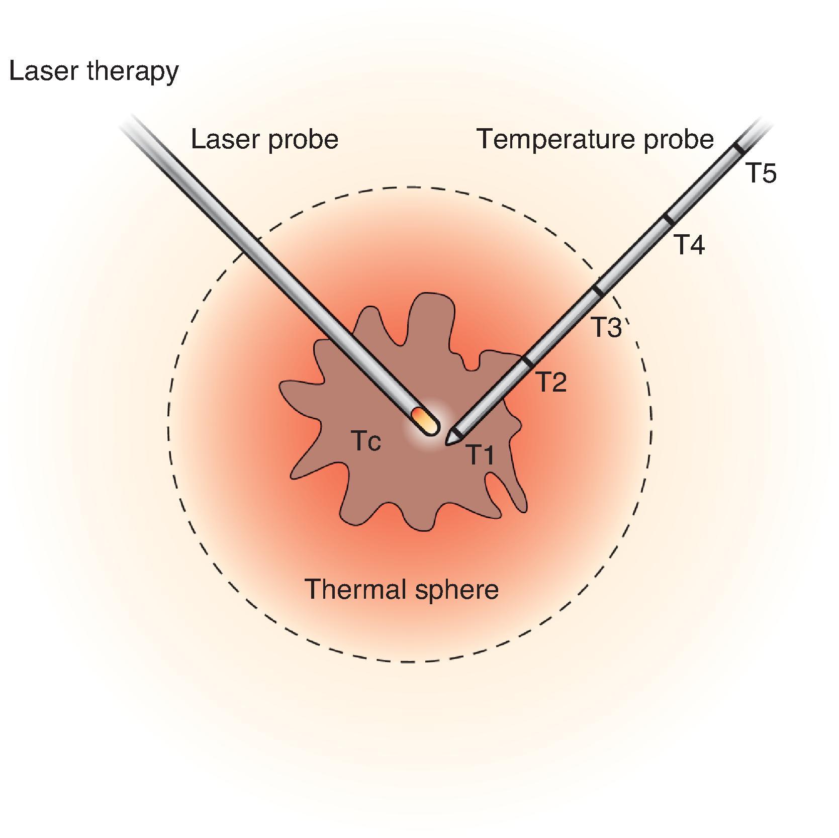 FIG. 4, Laser and temperature probes in and adjacent to a breast cancer. (From Dowlatshahi K, Francescatti DS, Bloom KJ. Laser therapy for small breast cancers. Am J Surg. 2002;184:359–363.)