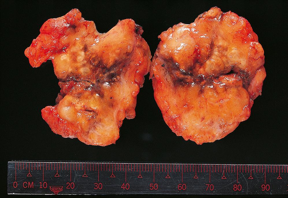 E-Fig. 18.3 G, Fat necrosis. F/42. Note the variegated colour and areas of haemorrhage on the cut surface of this lump. It was gritty to cut because of the presence of spotty calcification.