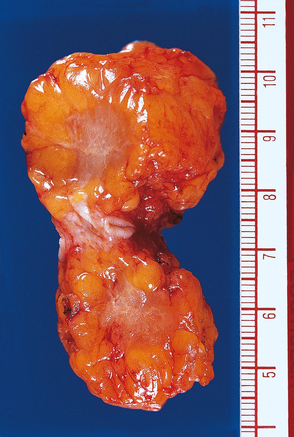 E-Fig. 18.6 G, Carcinoma of the breast. F/70. A breast lump removed for frozen section. When cut across, it was hard and gritty and the cut surface bulged inwards.