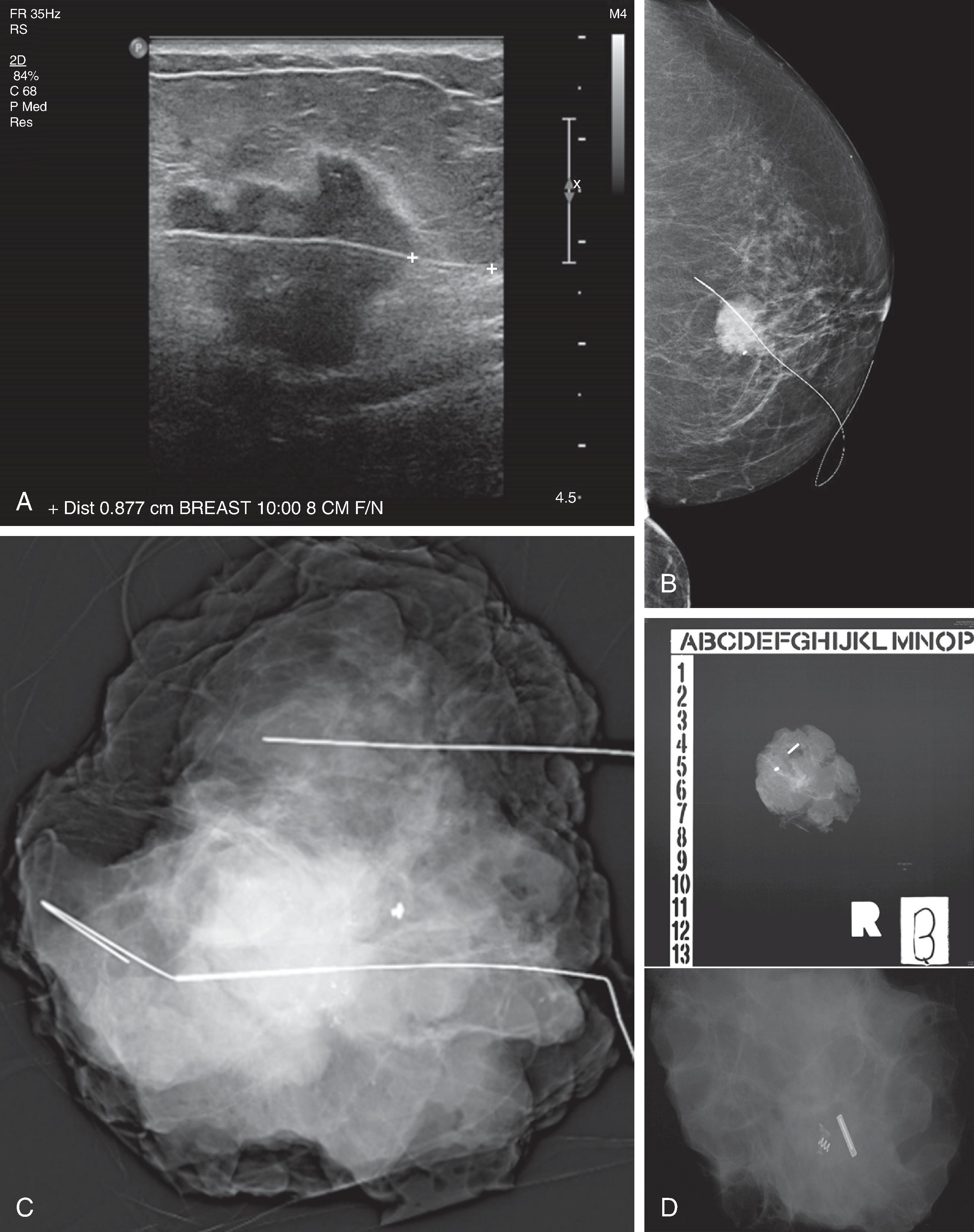 FIG. 1, Wire localized lumpectomy. (A) A localization wire is placed into a breast mass under ultrasound guidance. (B) The position of the localization wire is confirmed mammographically. (C) An intraoperative specimen radiograph of the lumpectomy specimen confirms successful excision of the mass and biopsy clip. (D) A specimen radiograph of a lumpectomy with radioactive seed localization (alternative to wire localization).