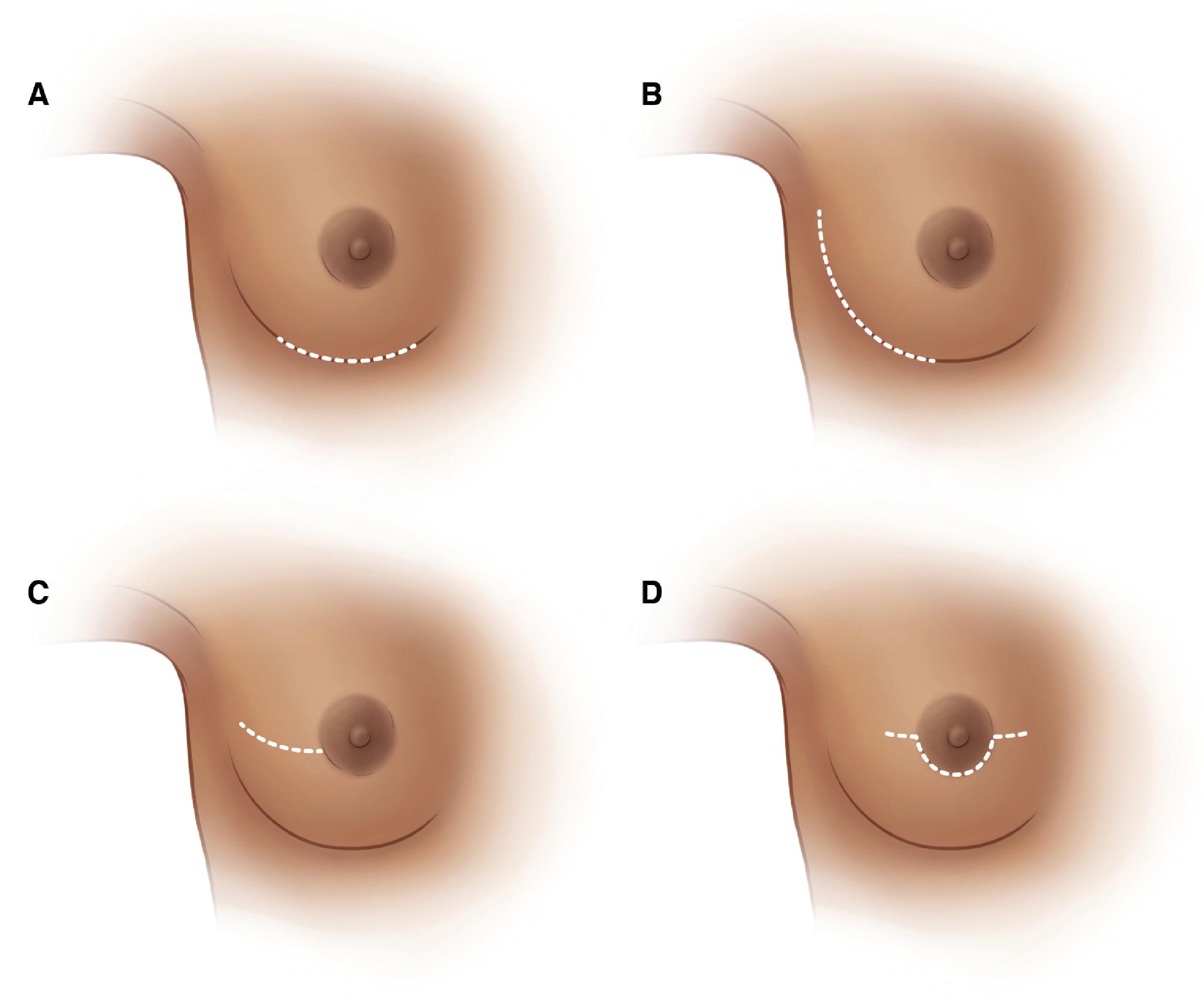 FIG. 2, Nipple-sparing mastectomy incisions. (A) Inframammary. (B) Inferolateral. (C) Radial. (D) Periareolar. (Copyright 2021 Memorial Sloan Kettering Cancer Center.)